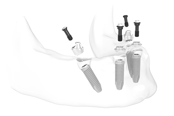 Das Bild zeigt die optimale Positionierung von All-on-4 Zahn-Implantaten am grafischen Modell des Unterkiefers, zwei Implantate gehen vorn senkrecht in den Kiefer, zwei weitere daneben auf 10 und 2 Uhr im angeschrägten Winkel von hinten nach vor gehend.