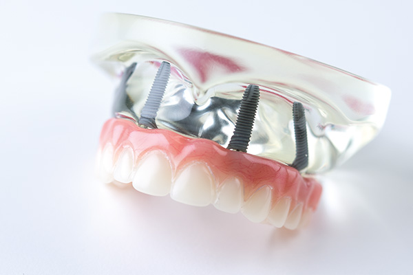 All-on-4 Modell auf weißem Untergrund. Es zeigt des festen Zahnersatz auf 4 Zahn-Implantaten bei Zahnarzt Dr. Quidenus in Wien.