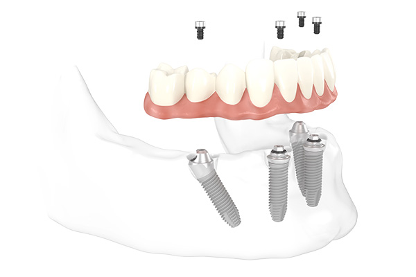 Zahnersatz wird auf vier Implantaten gesetzt und verschraubt - Zeichnung und Modell des All-on-4-Modells